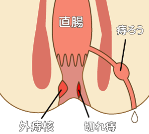 ろう 痔